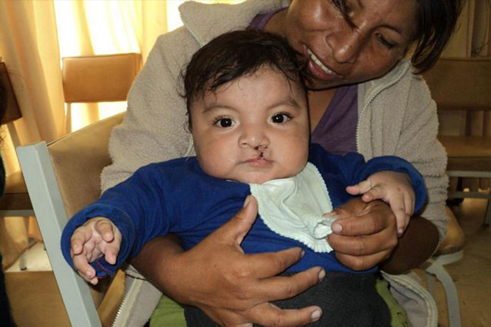 Jhon Bruce Lee after cleft surgery