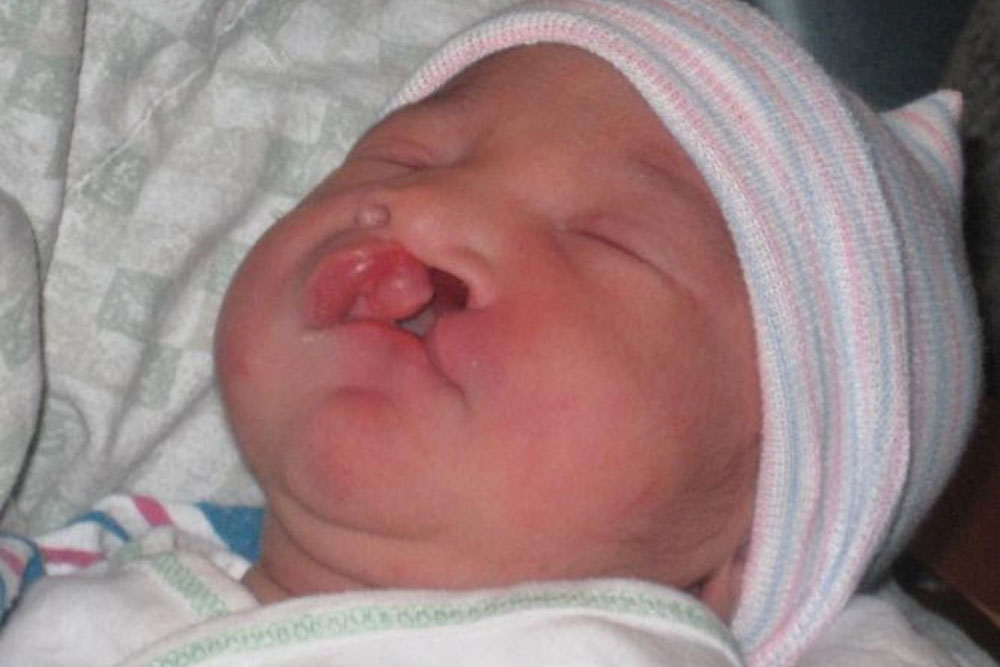 Dahlila as a baby, before cleft surgery