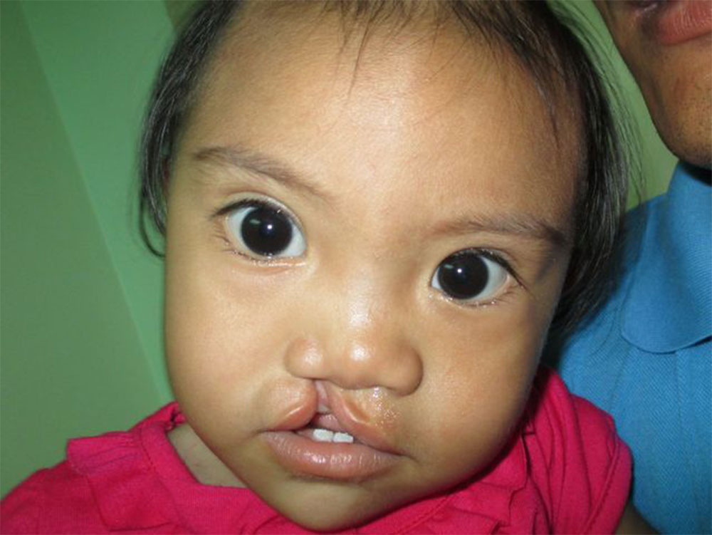 Angel before cleft surgery