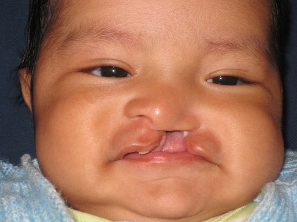 Luis as a newborn, before cleft surgery