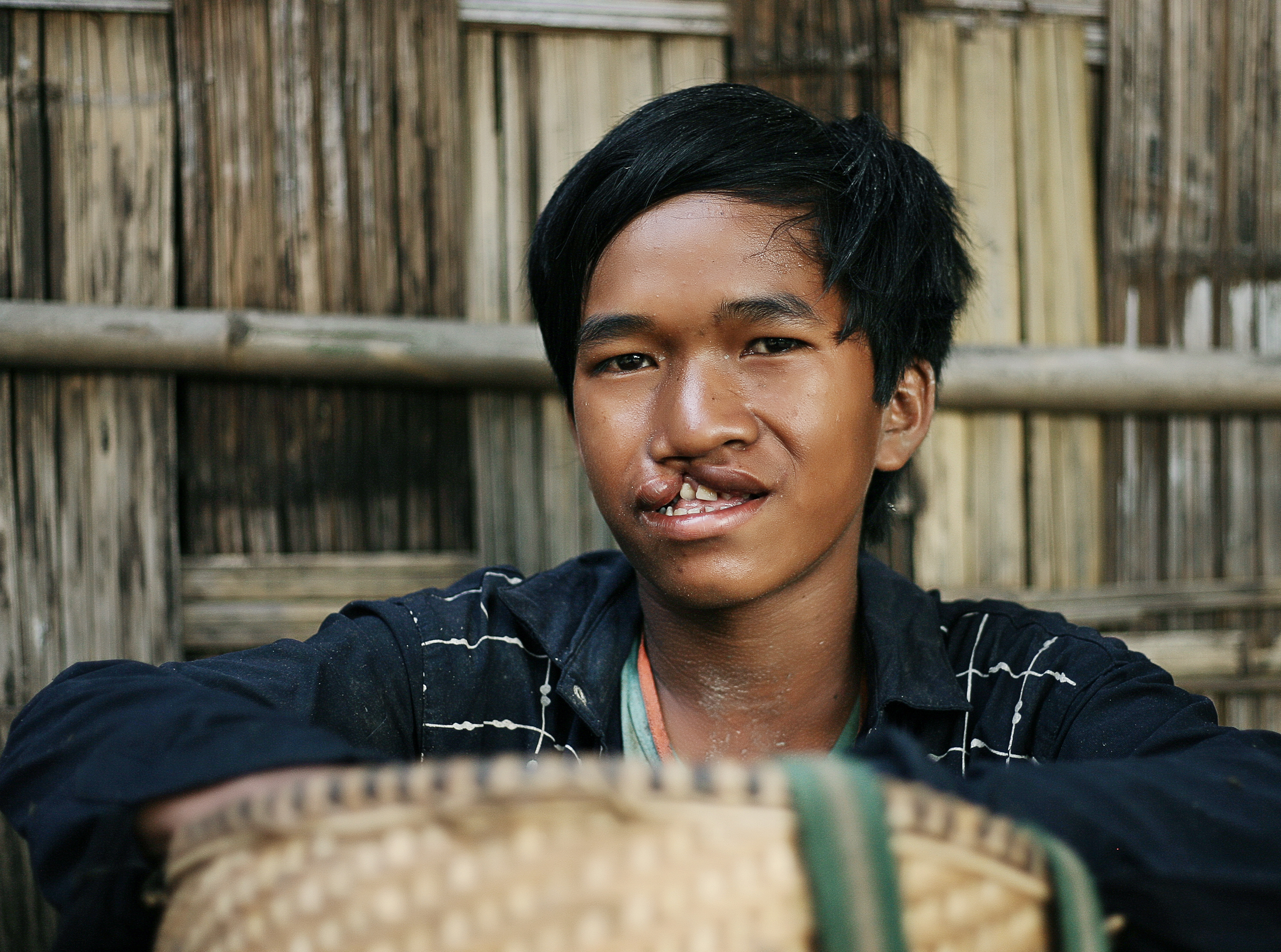 Ray before cleft surgery holding a basket