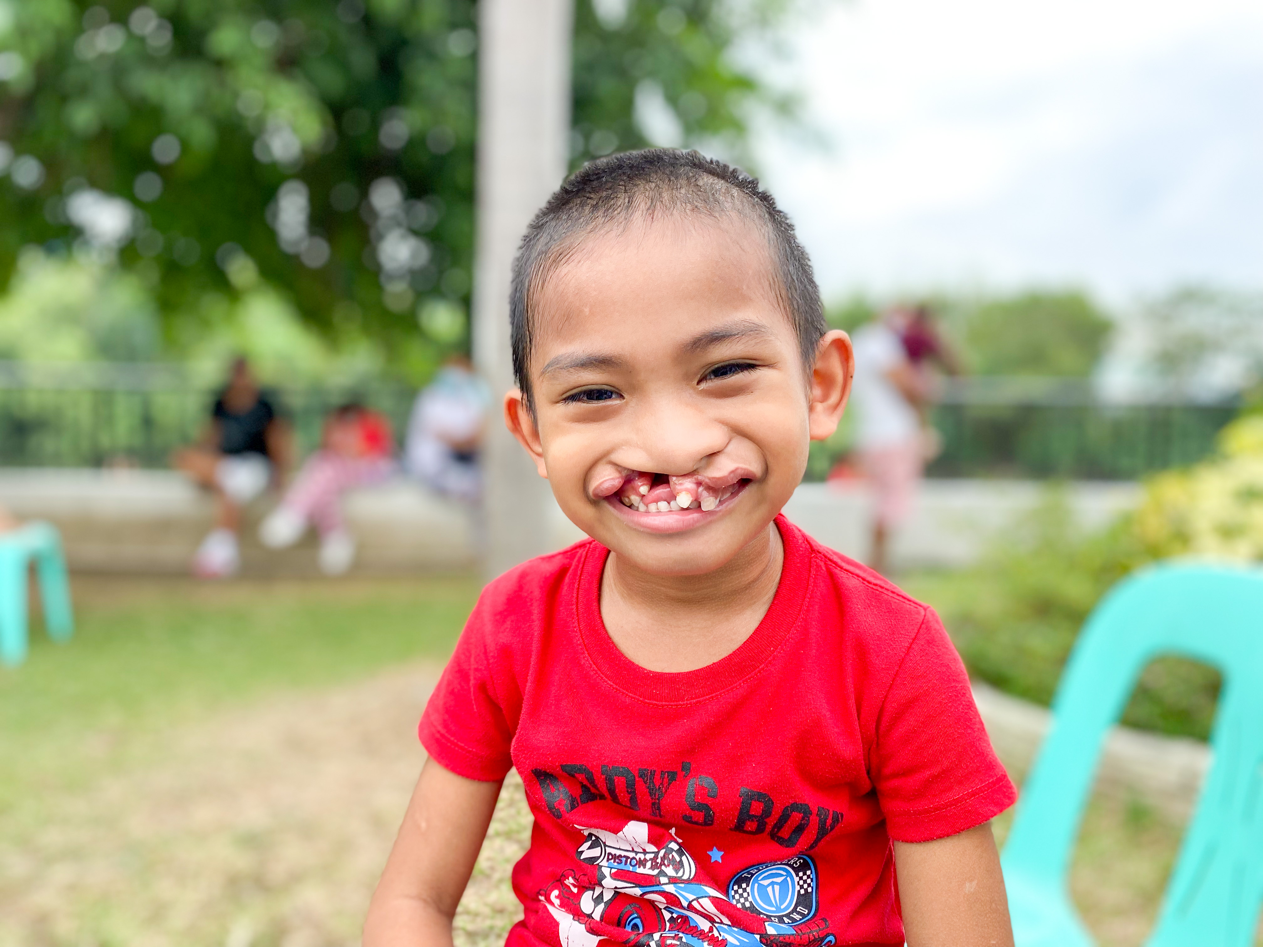 Kyle smiling before his cleft surgery