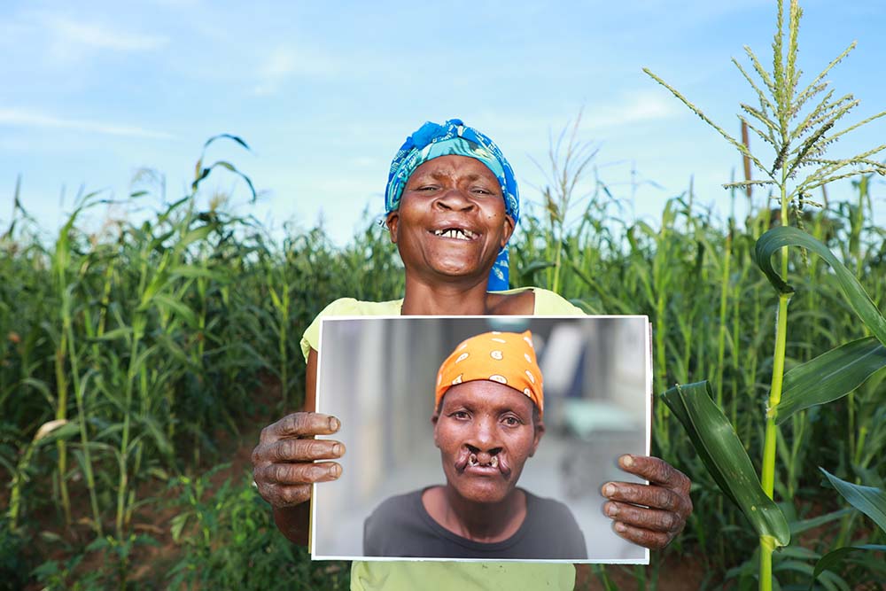 Zita holding a photo of herself before cleft surgery