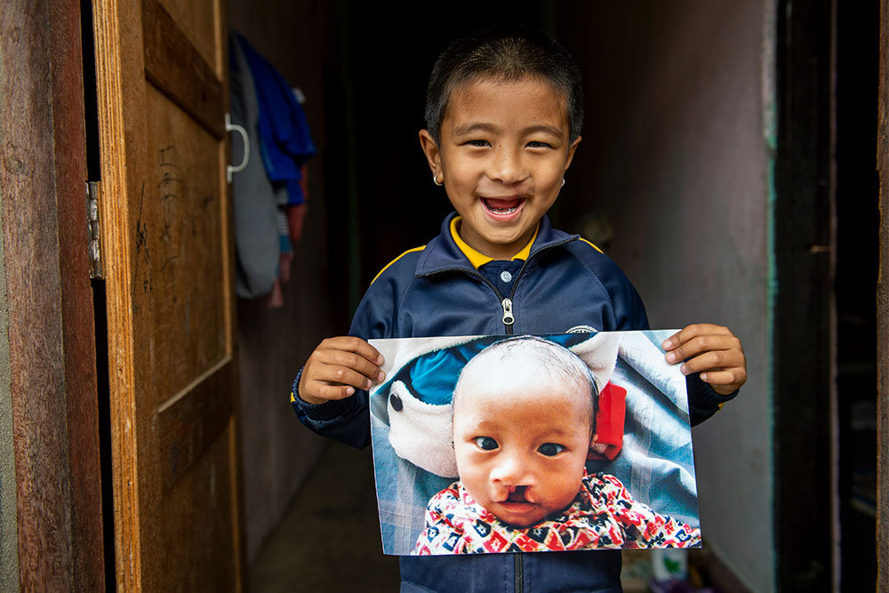 Smile Train patient Jenious from Nepal holding a picture of himself before cleft surgery and smiling