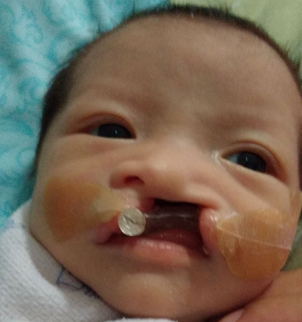 Alex as an infant, before cleft surgery