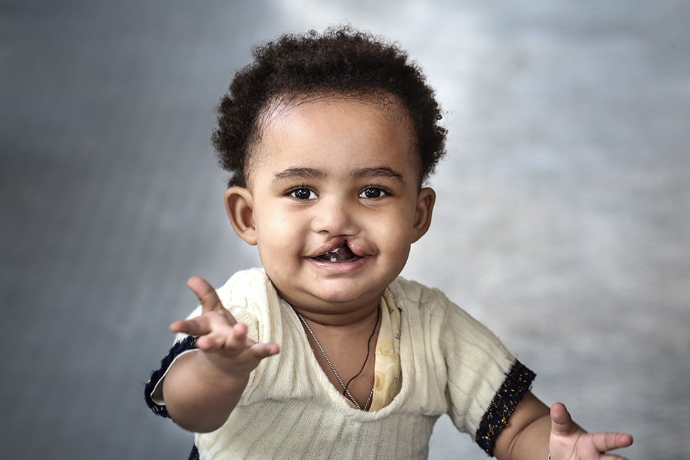 A professional photograph of Marsillas before cleft surgery