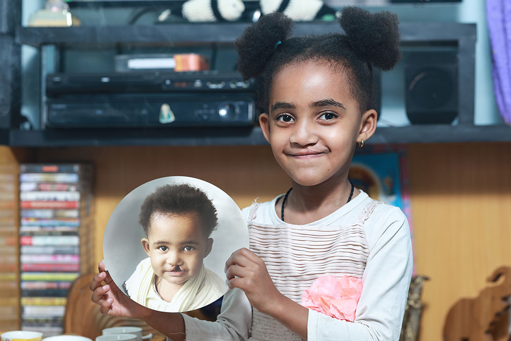 Marsillas holding a picture of herself before cleft surgery