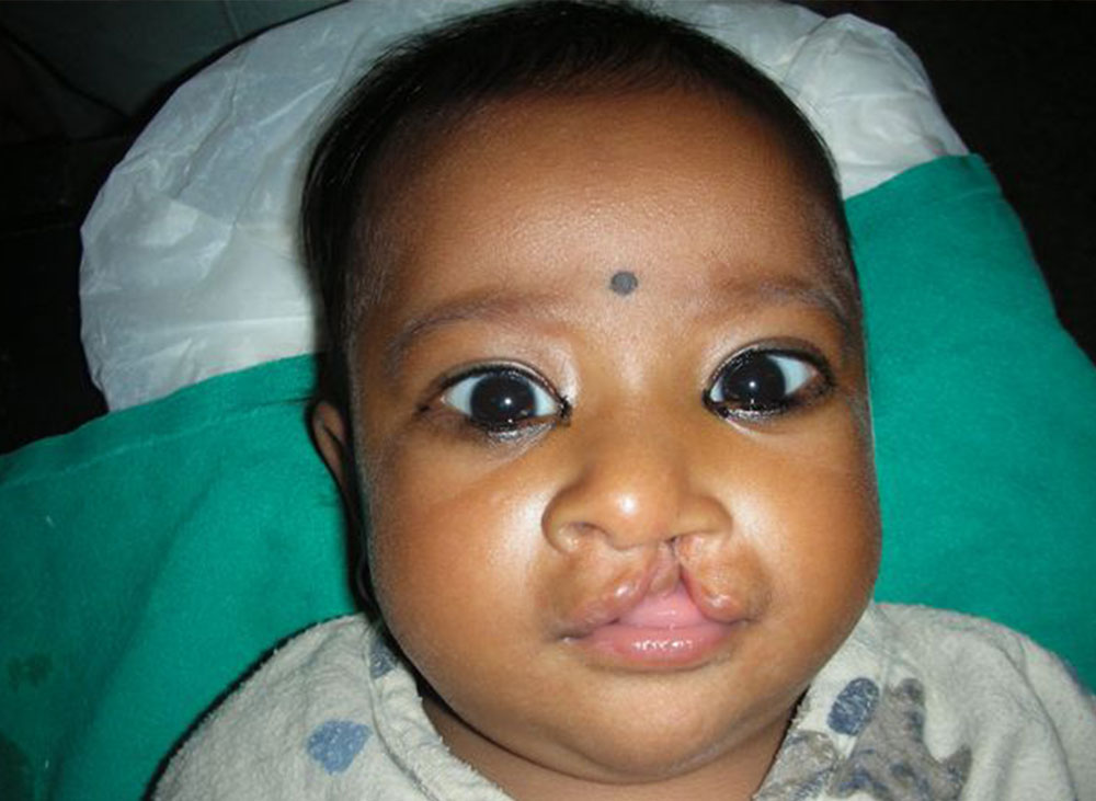 Simrik as an infant before cleft surgery
