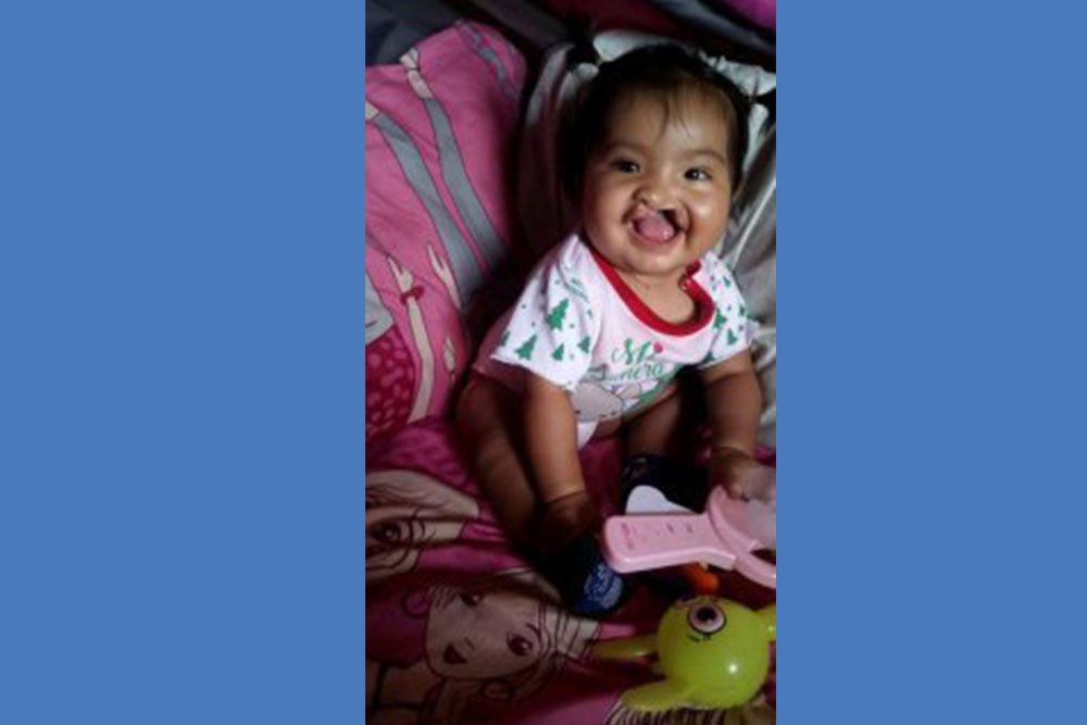 Shaymi before cleft surgery
