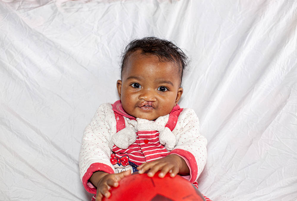 Tsiorihasina smiling before cleft surgery