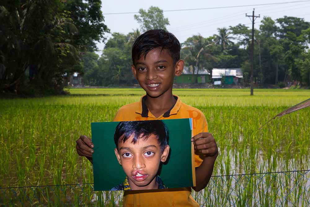 Trinoy holds up a picture of himself before cleft surgery