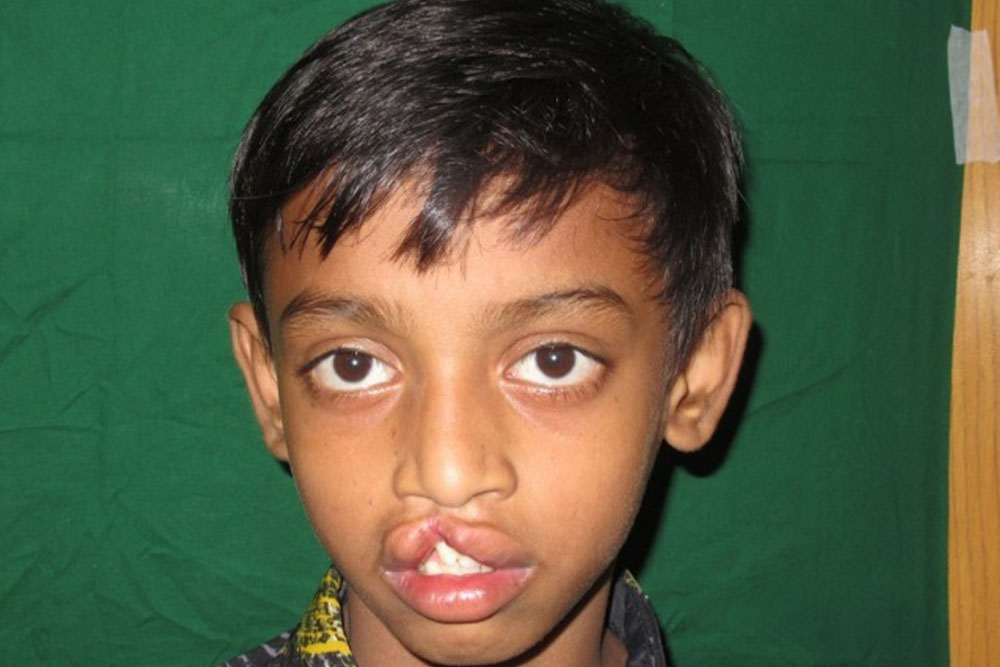 Trinoy before cleft surgery