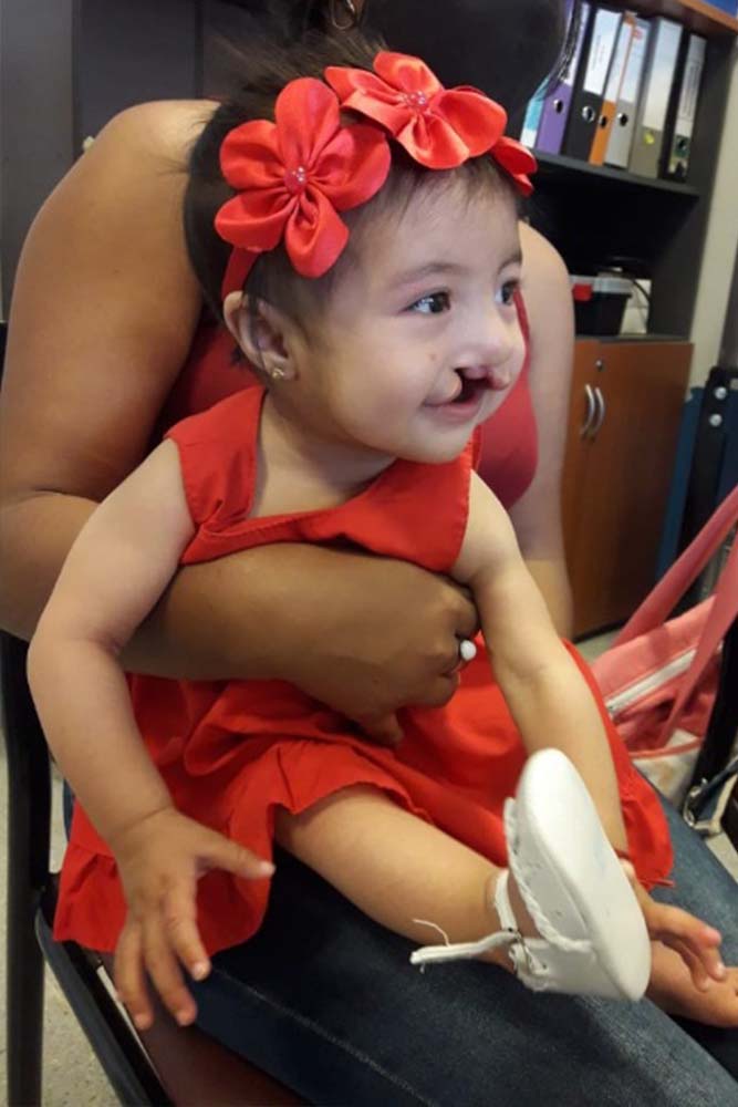 Isabella before cleft surgery