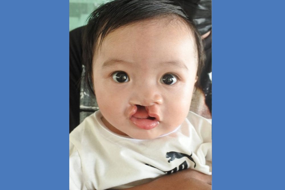 Zabriena before cleft surgery