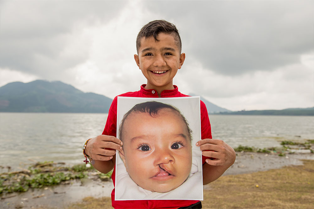 Jesus holds up a photo of himself from before cleft treatment