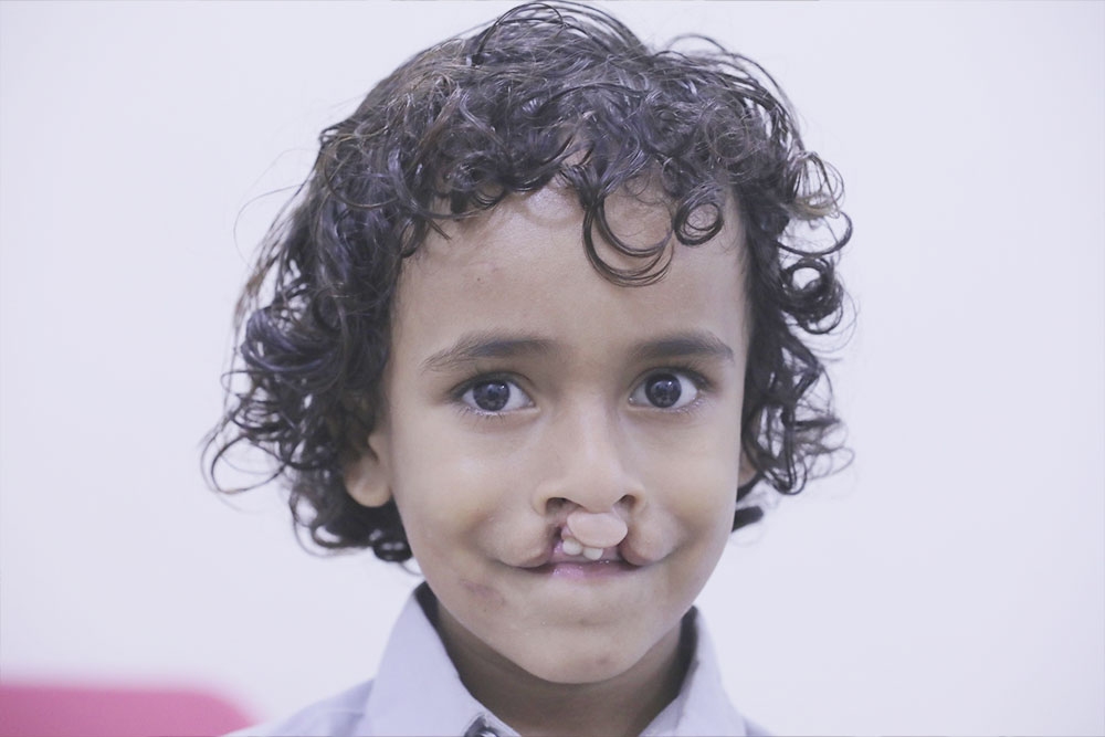 Bilal before cleft surgery