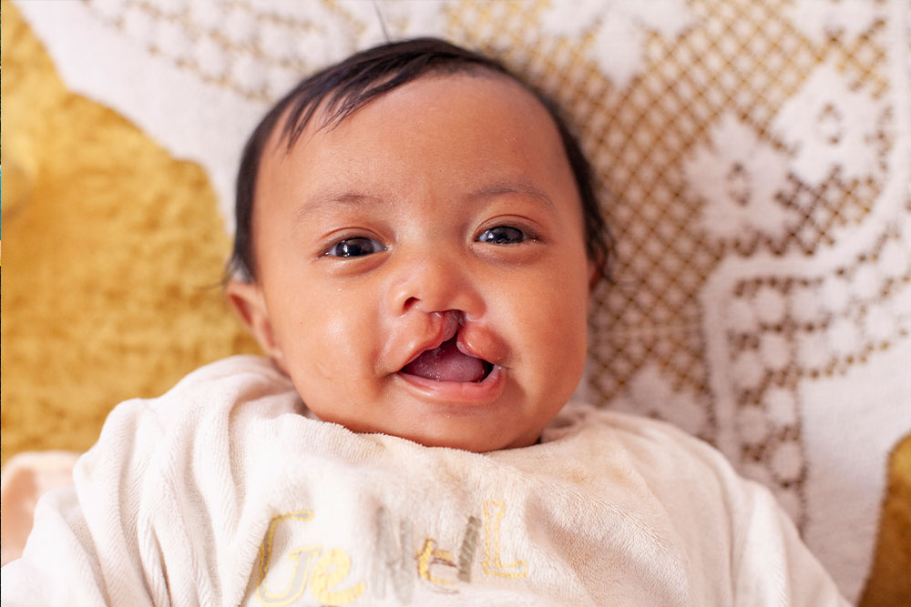 Eden before cleft surgery
