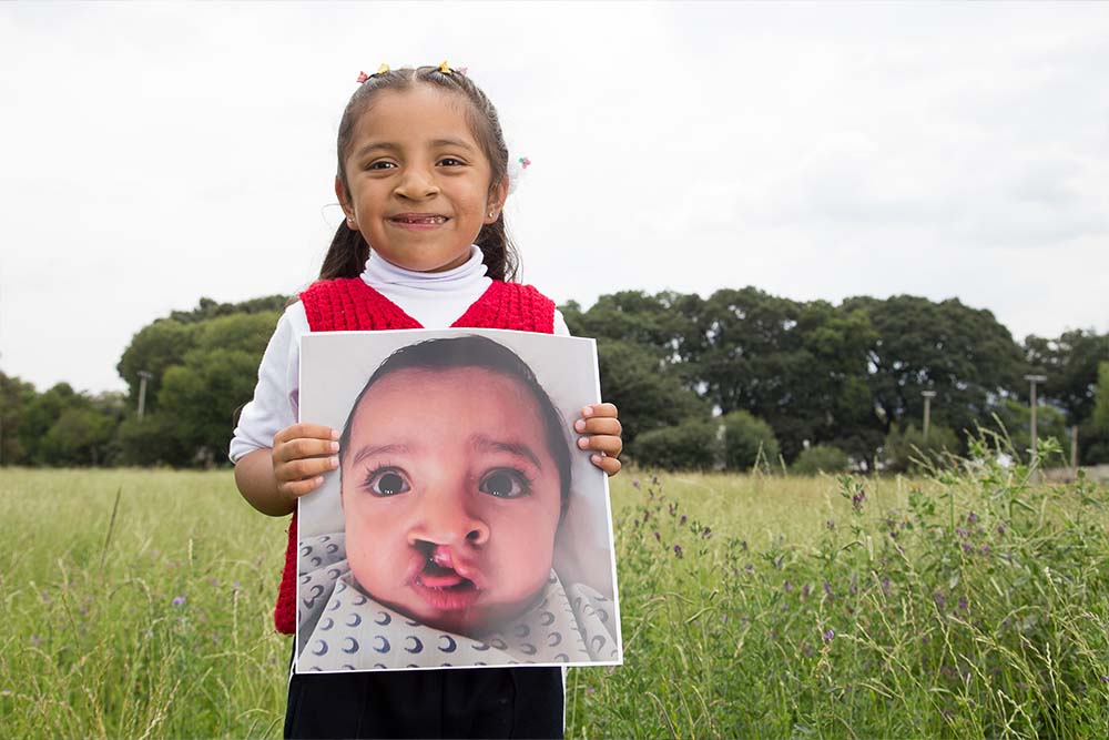 Ivanna holds up a photo of herself before cleft treatment
