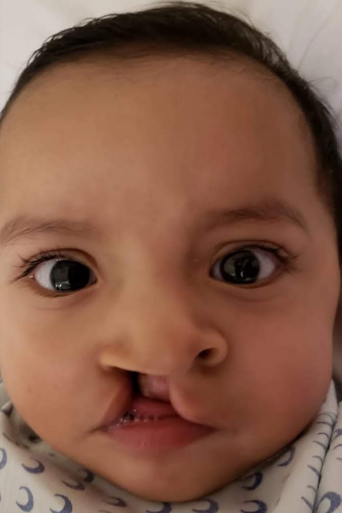A baby photo of Ivanna before she received cleft surgery