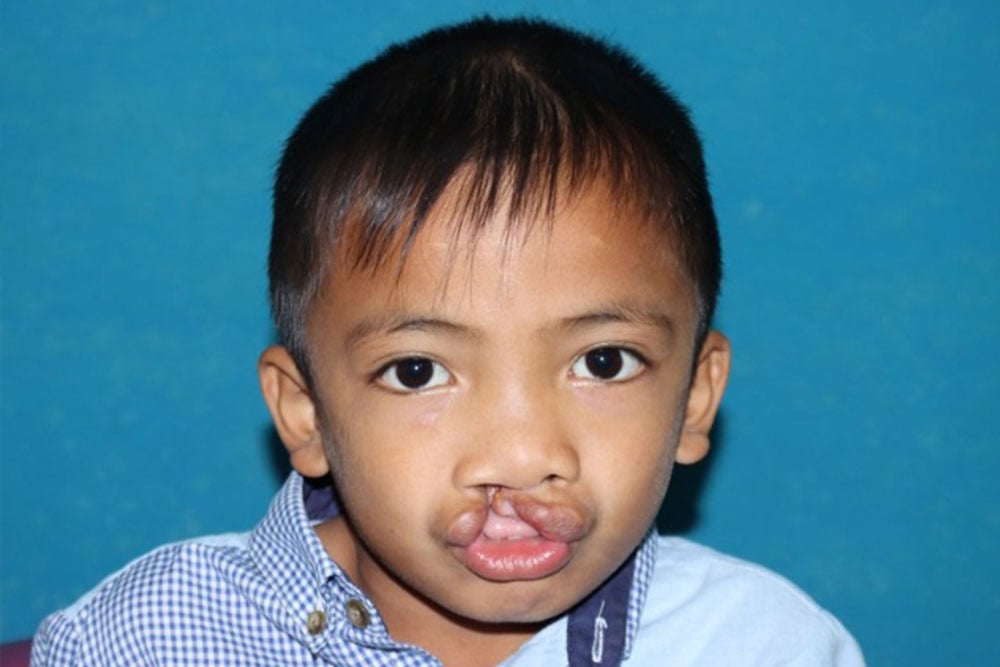 Anuwat before cleft surgery