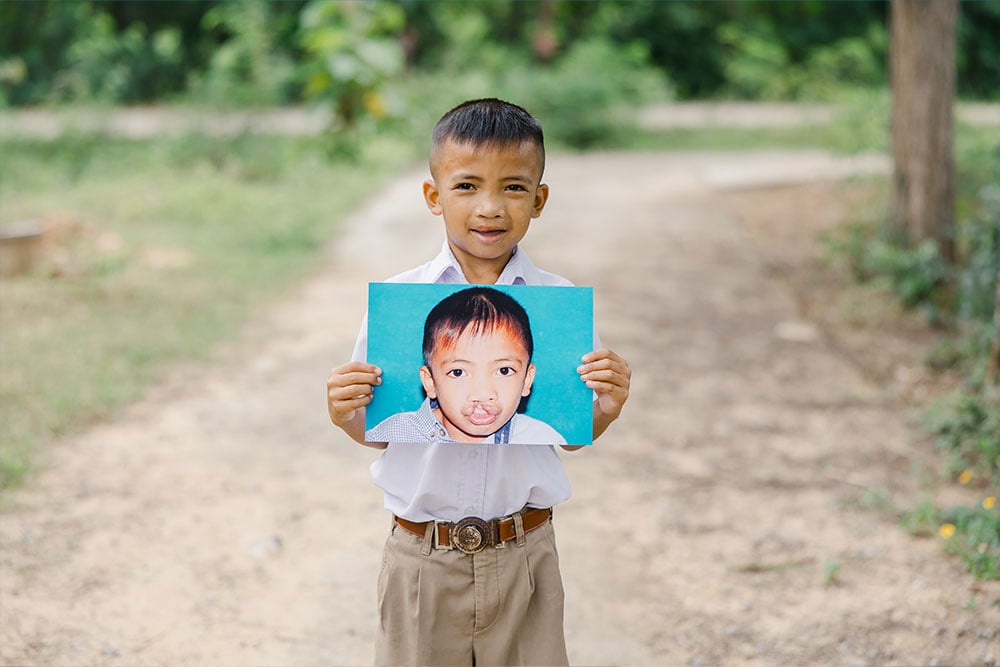 Anuwat smiling and holding a picture of himself before cleft surgery