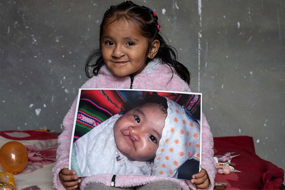 Roselin holding a picture of herself from before cleft surgery procedures