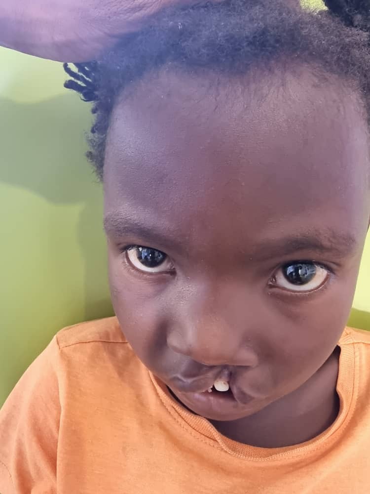 Janerose before cleft surgery