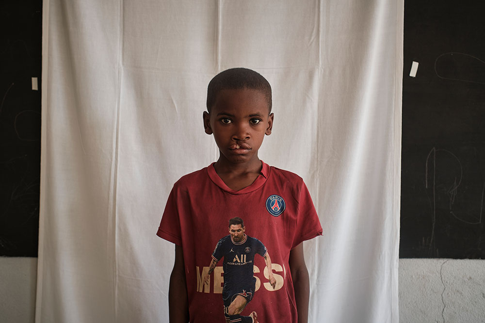 Ferdinand before cleft care Madagascar