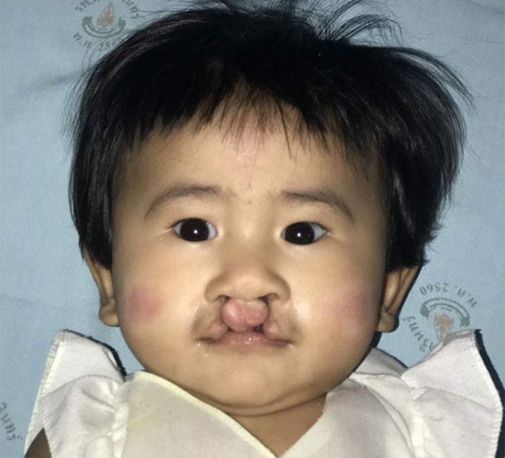Niu before cleft surgery