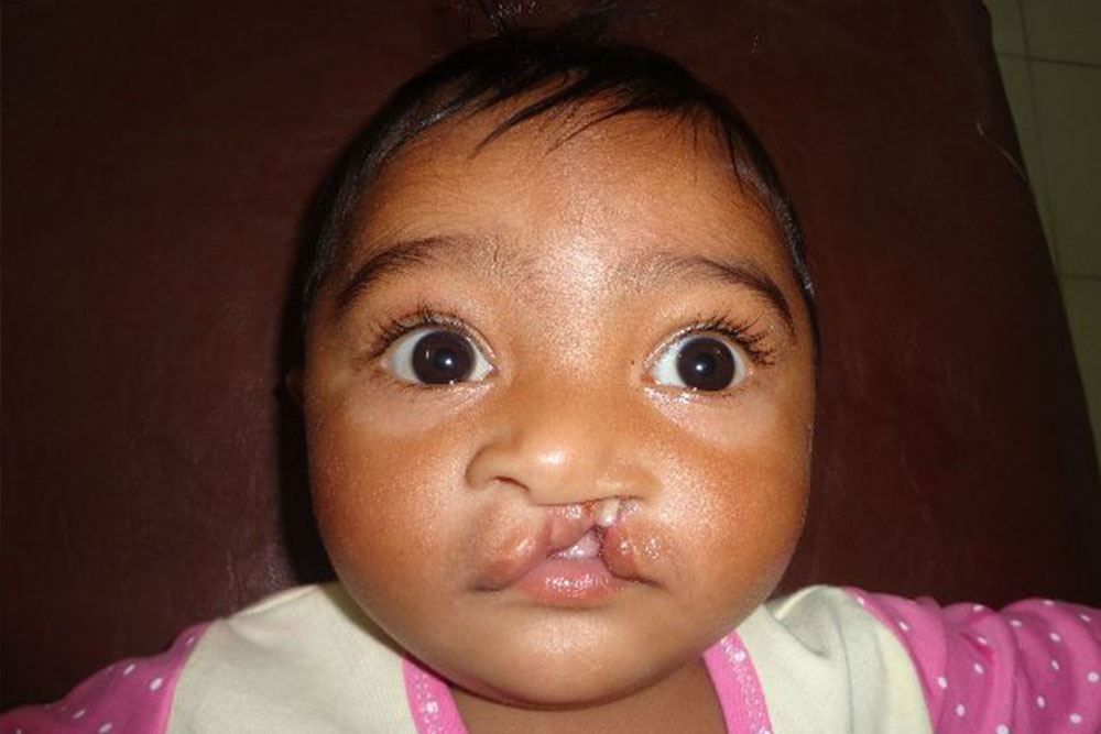 Maimun as a baby, before cleft surgery