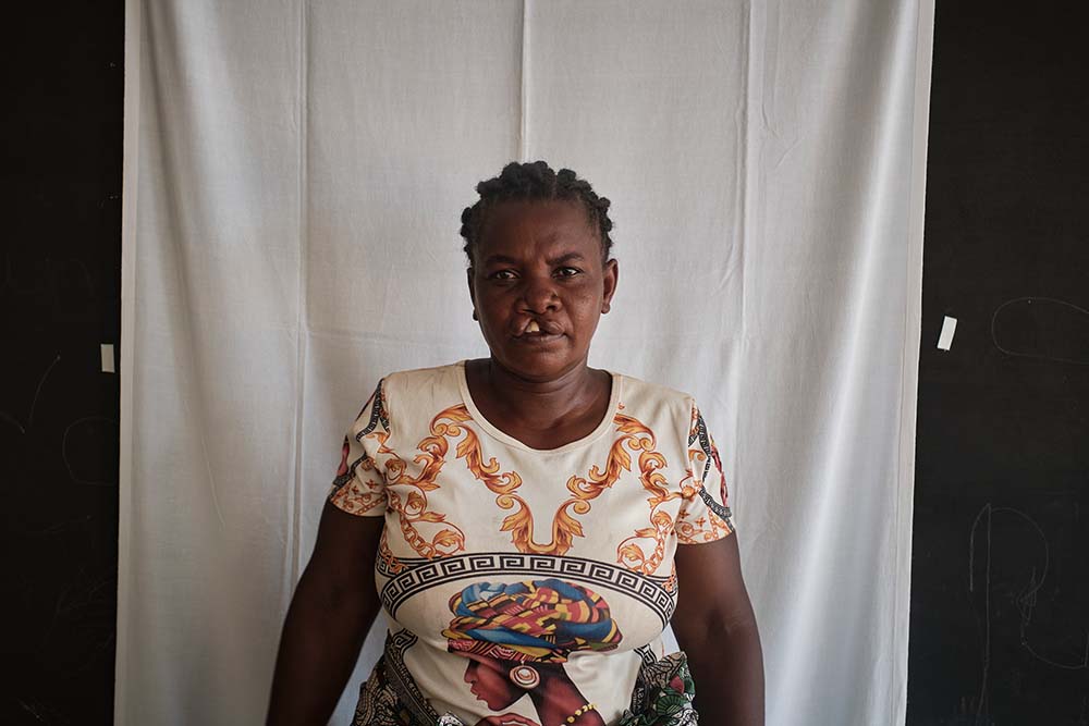 A photo of Rasoafine from before cleft treatment
