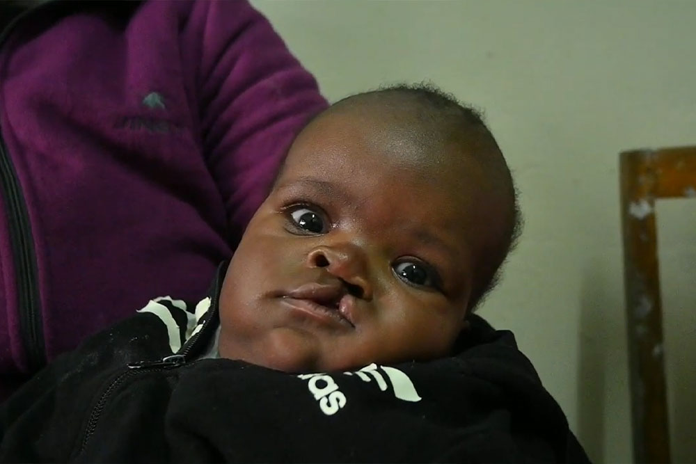 Baby Rozzy before cleft surgery in Kisumu, Kenya
