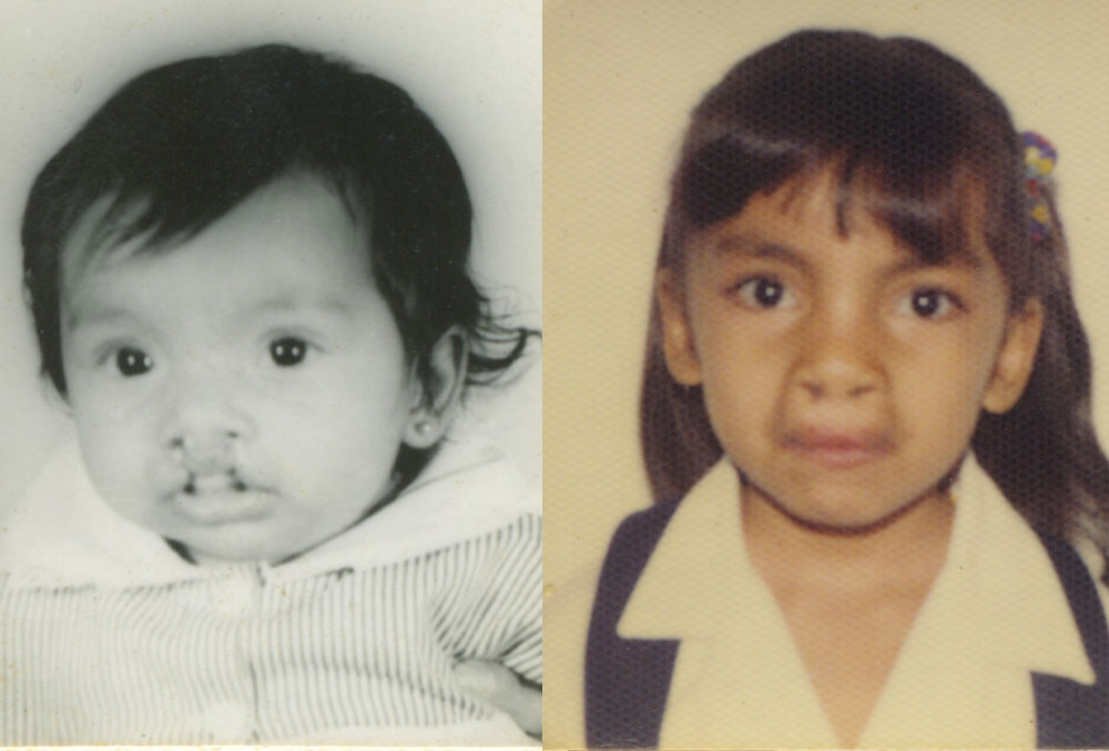 Adahara before and during treatment for her cleft lip and cleft palate