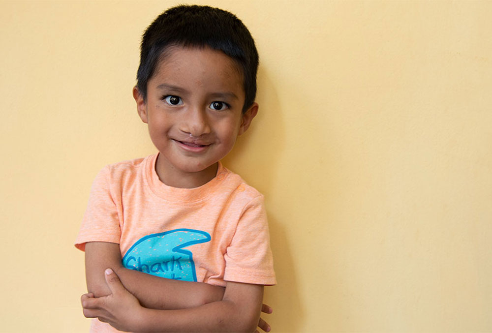 Anghelo as a school-aged boy, smiling after his free cleft lip and palate surgery in Peru