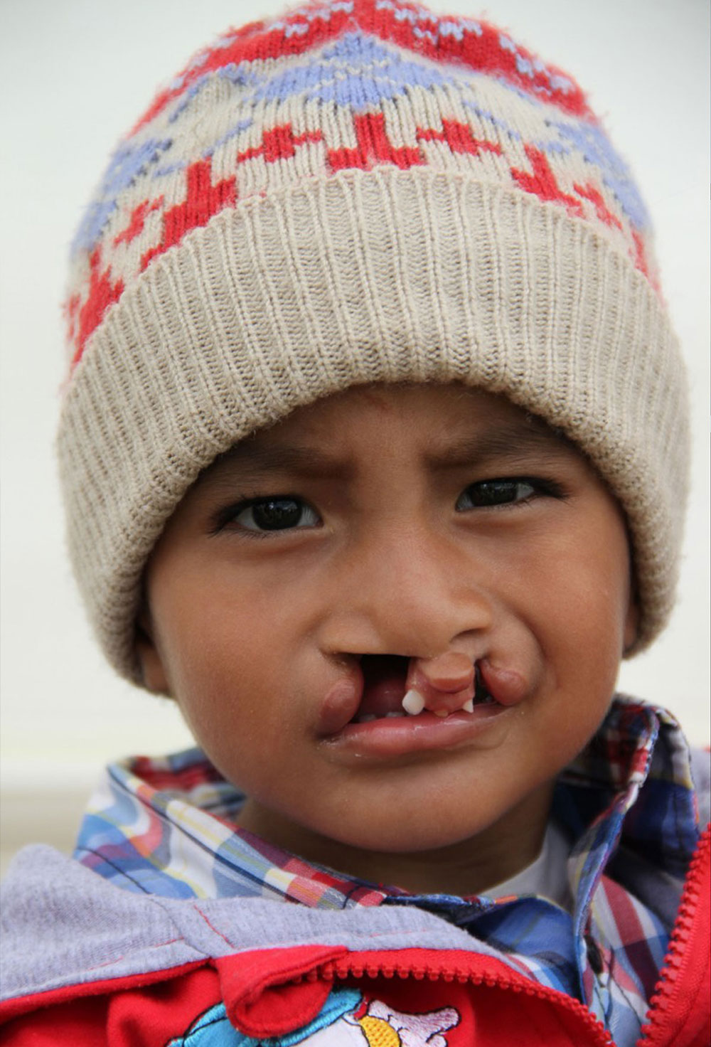 Anghelo before his free cleft lip and palate surgery in Peru