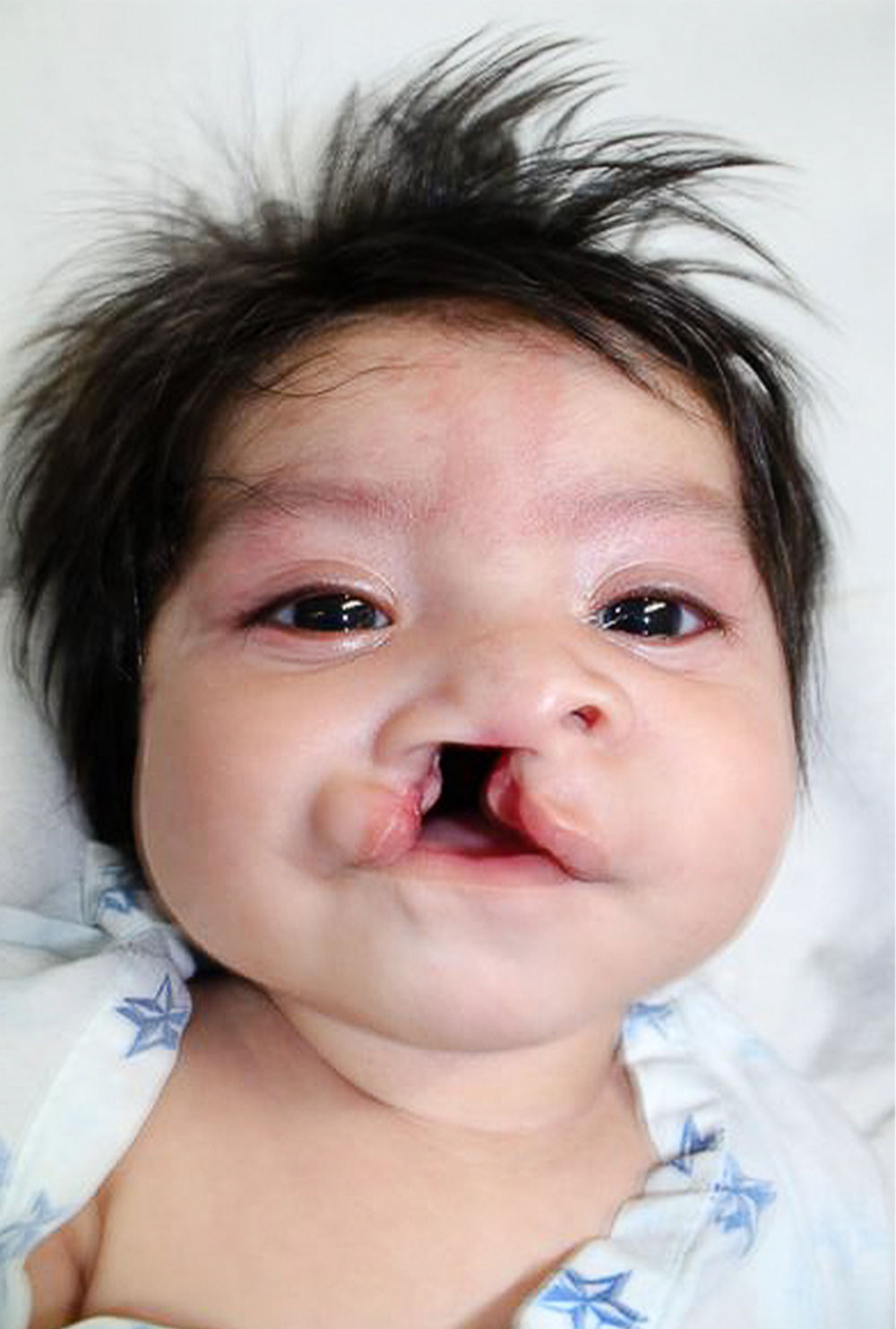 Barbara before her free Smile Train-sponsored cleft treatment
