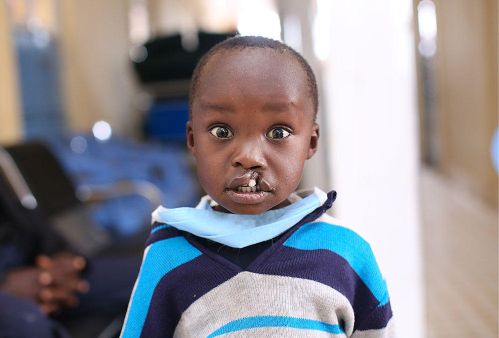 Benjamin before free Smile Train-sponsored cleft surgery