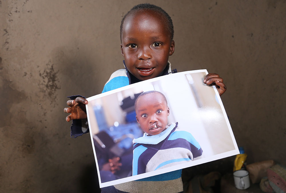 Benjamin holding a picture of himself before free Smile Train-sponsored cleft surgery