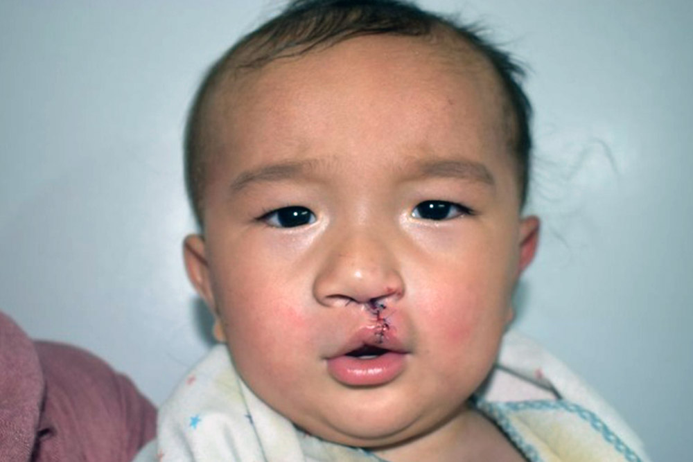Afghan child after cleft surgery at BeTeam Hospital in Kabul