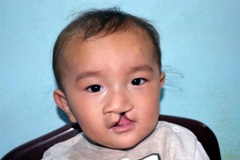 Afghani child before cleft surgery at BeTeam Hospital in Kabul