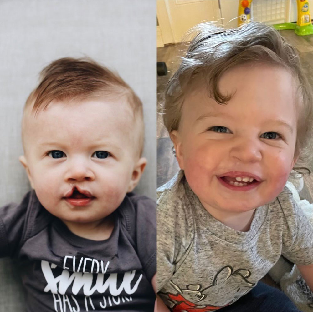 Greyson Reeser before and after cleft surgery