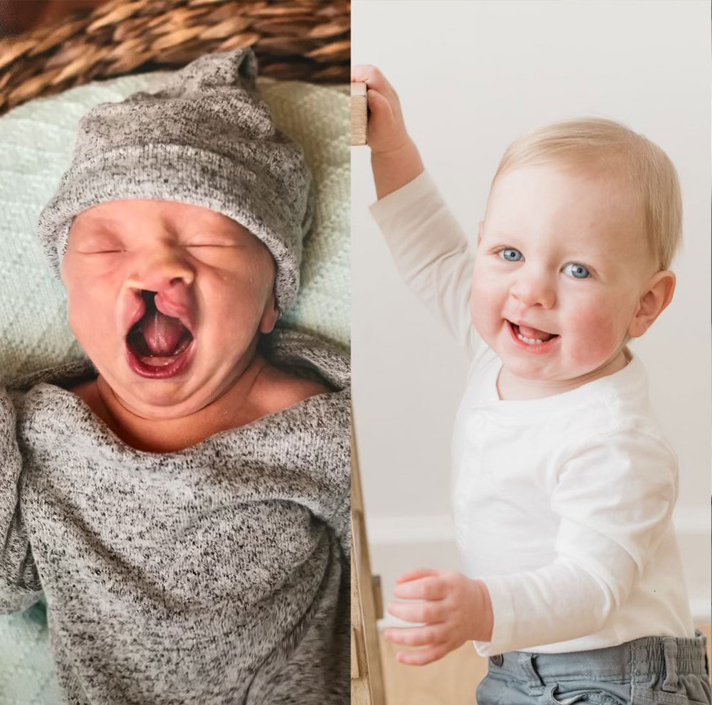 Miles Fiddes before and after cleft surgery