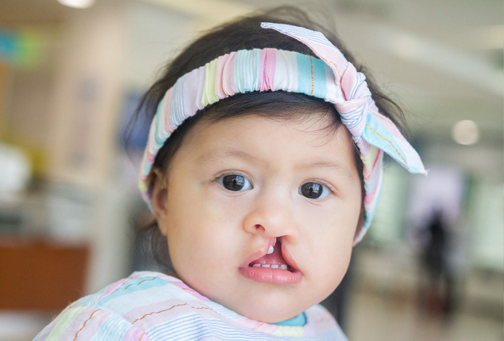 Gianna before her cleft lip and palate surgery, but after her mother received guidance on how to feed her.