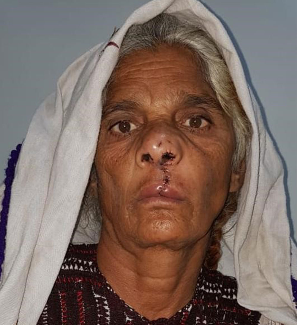 Pyari after her cleft lip and cleft palate surgery at age 70