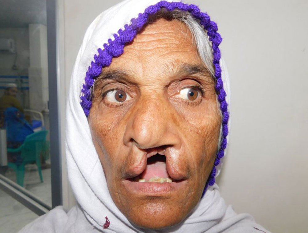 Pyari before her cleft lip and cleft palate surgery at age 70