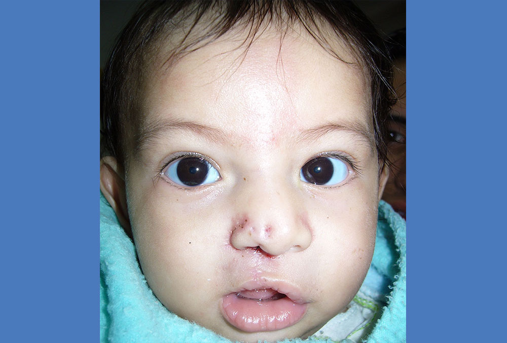 Cristian after his first cleft surgery