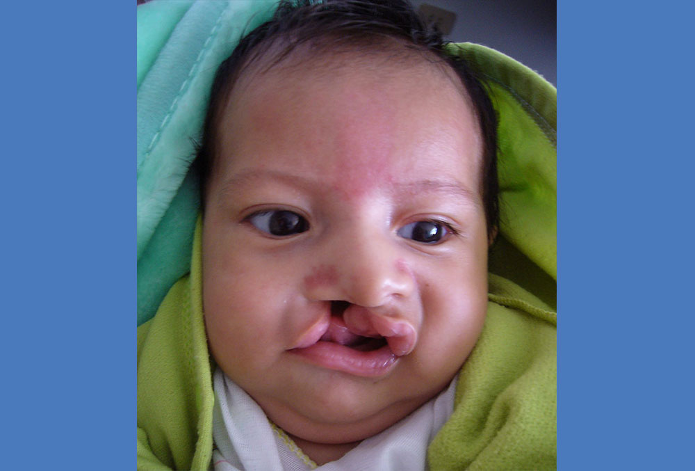 Cristian before cleft surgery