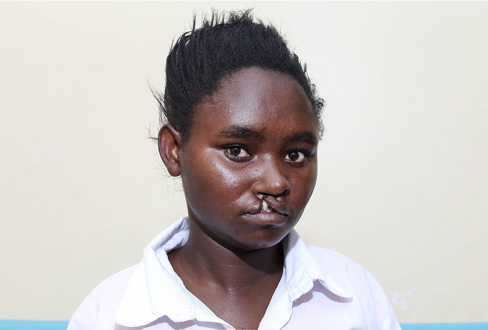 Damaris before her life-changing free cleft surgery sponsored by Smile Train