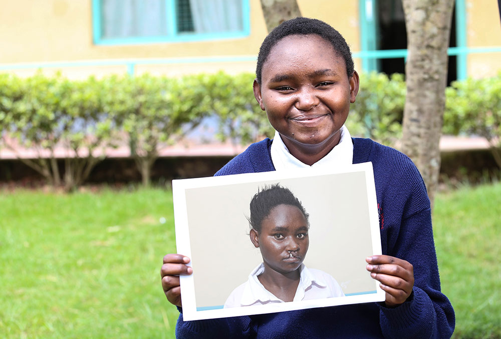 Damaris smiling and holding a picture of herself before her life-changing cleft surgery sponsored by Smile Train