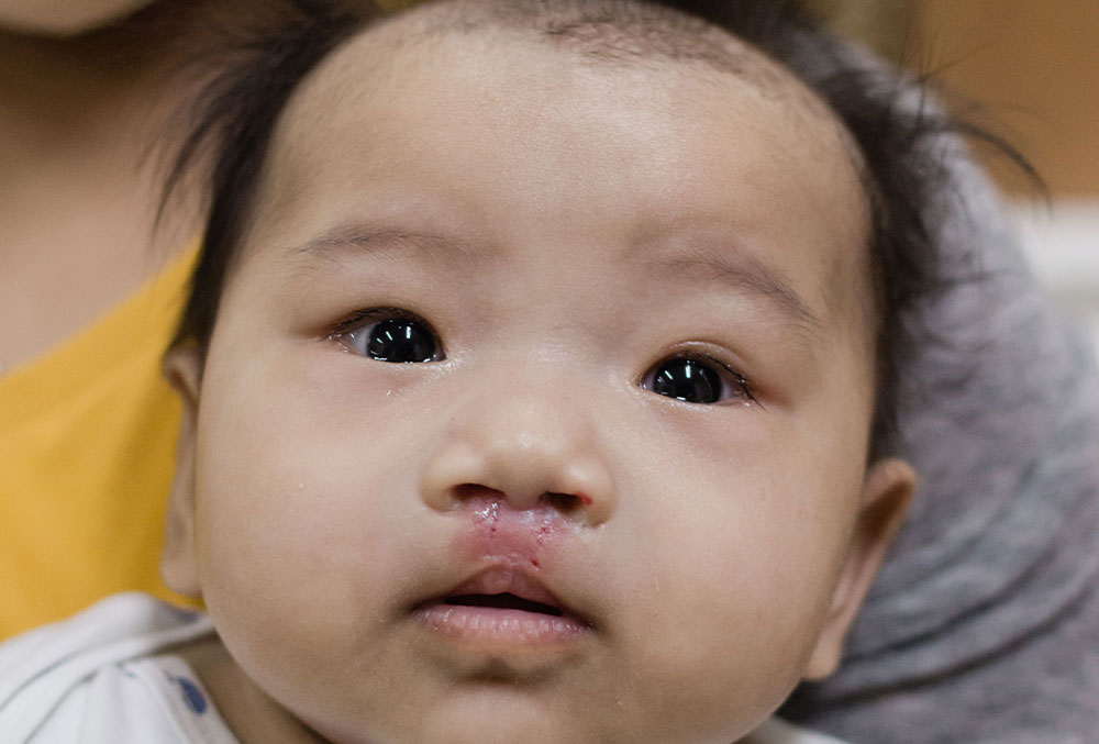 Elizabeth after cleft surgery